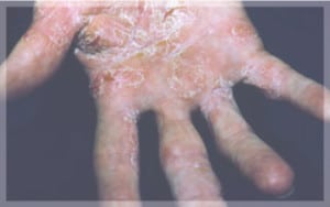 4ผื่นสะเก็ดเงิน-Pustular-Psoriasis-มือ