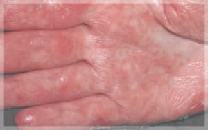 5ผื่นสะเก็ดเงิน-Erythrodermic-Psoriasis-มือ